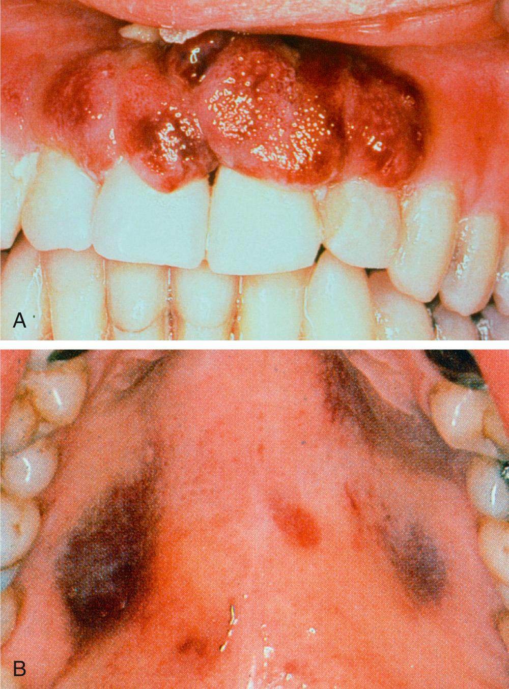 Fig. 10.1, (A) Nodular Kaposi sarcoma of the gingiva. Given the ulcerated and fungating appearance, the differential diagnosis includes non-Hodgkin lymphoma and squamous cell carcinoma. Biopsy is appropriate to establish the diagnosis. (B) Mucosal Kaposi sarcoma of the hard palate. This demonstrates a characteristic macular appearance. In the appropriate clinical setting, biopsy is not needed to confirm the diagnosis.