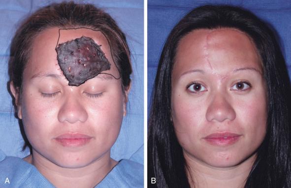 Figure 14.1, (A) Wound covered with silver-coated dressing with preoperative markings showing extension of the wound boundary. (B) Iatrogenic extension of the wound boundaries allows for the incision line to be hidden in the hairline.