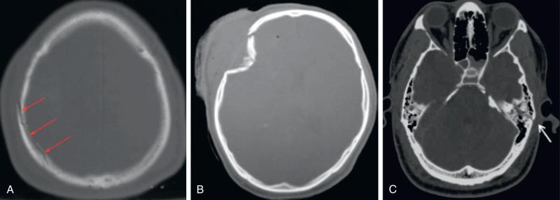 Fig. 122.2, Axial computed tomography images demonstrating a linear cranial vault fracture at the parietal bone as indicated by arrows (A), depressed cranial vault fracture at the frontal bone (B), and linear skull base fracture through the petrous portion of the temporal bone (arrow pointing to left temporal bone illustrates fracture line) (C).