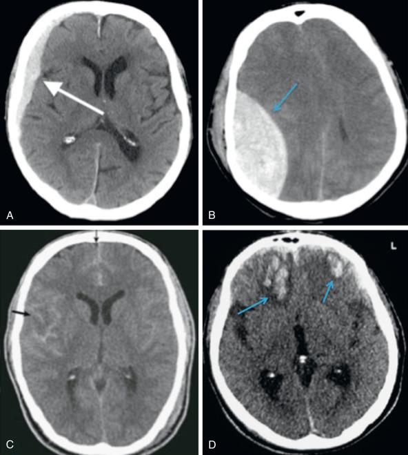 Fig. 122.3, Axial computed tomography scans demonstrating intracranial hemorrhages. (A) Acute right subdural hematoma (arrow) following the contour of the brain. Note the concave shape. (B) Acute right epidural hematoma (arrow) confined between the coronal and lambdoid sutures. Note the convex shape. (C) Acute traumatic right frontal and temporal subarachnoid hemorrhage (arrow) . (D) Bilateral frontal basal contusion (arrow) where the brain interfaces with the rough base of the anterior cranial fossa.