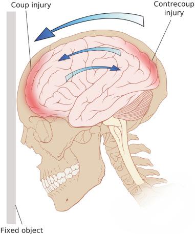 Fig. 123.1, Coup and contrecoup injuries.