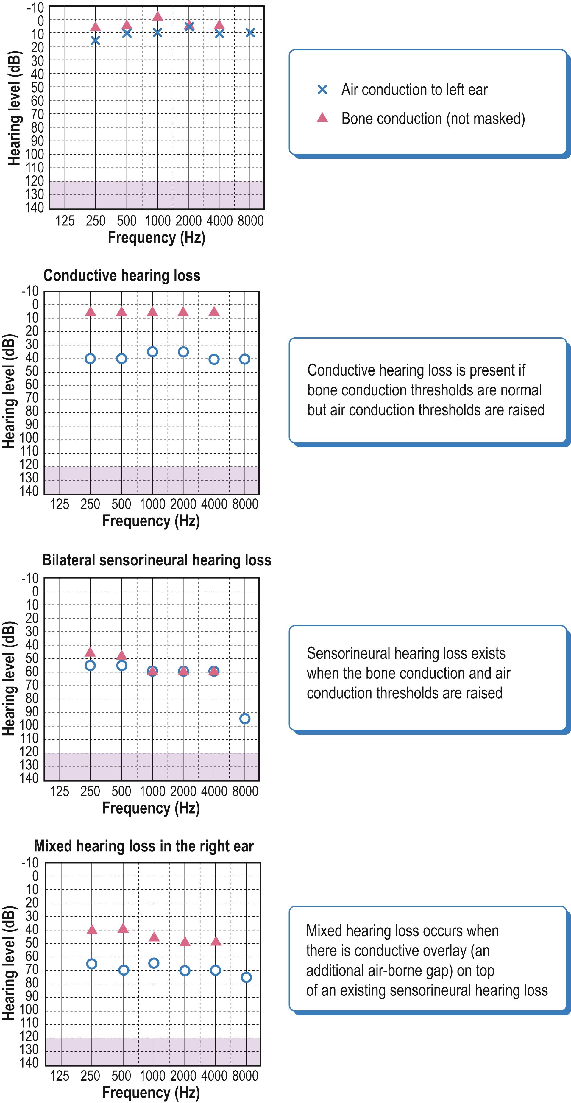 Fig. 18.1, Pure tone audiograms of normal, conductive, sensorineural and mixed loss.