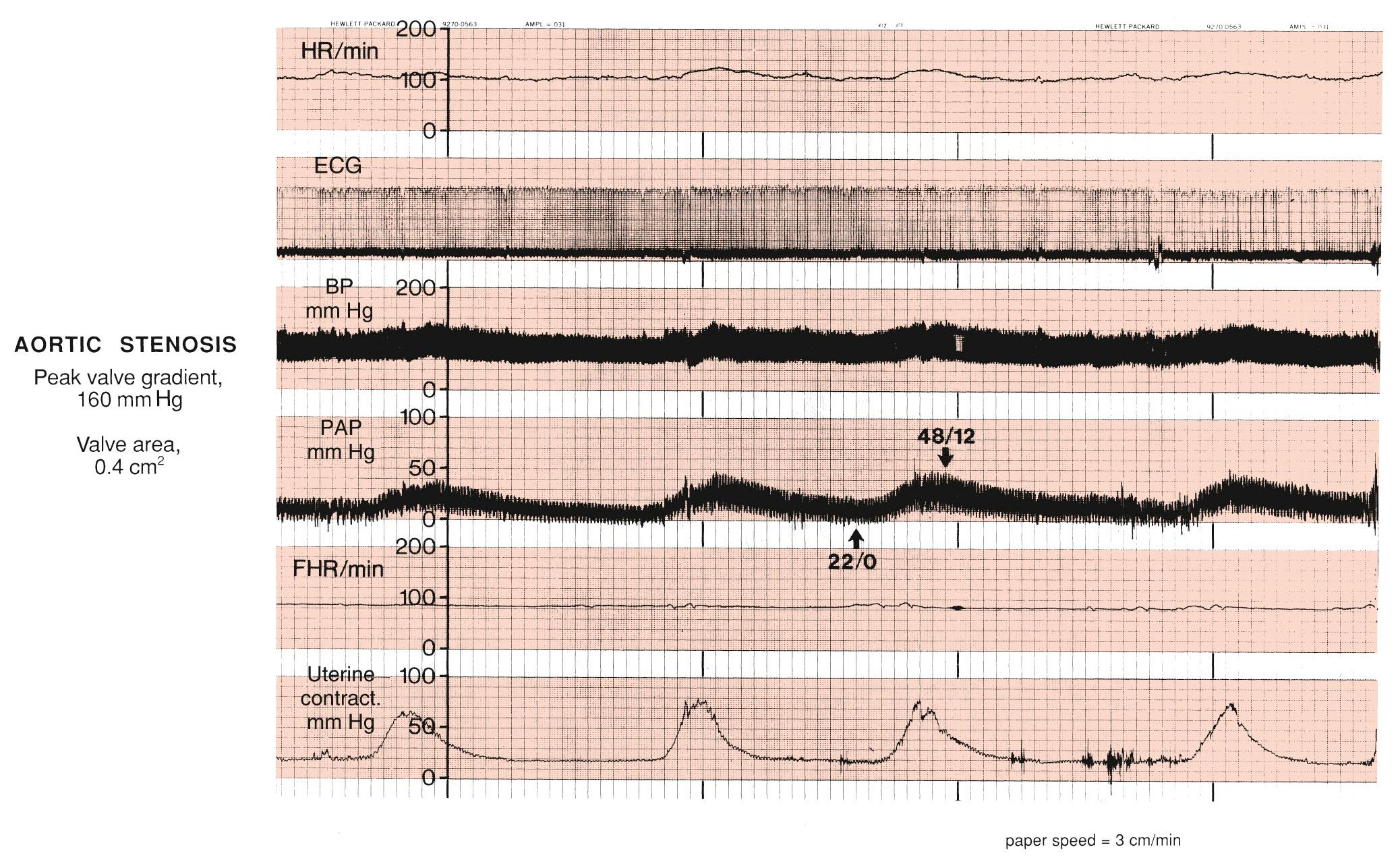 Fig. 42.3, Hemodynamic Monitoring of a Patient With Severe Aortic Stenosis in Labor.