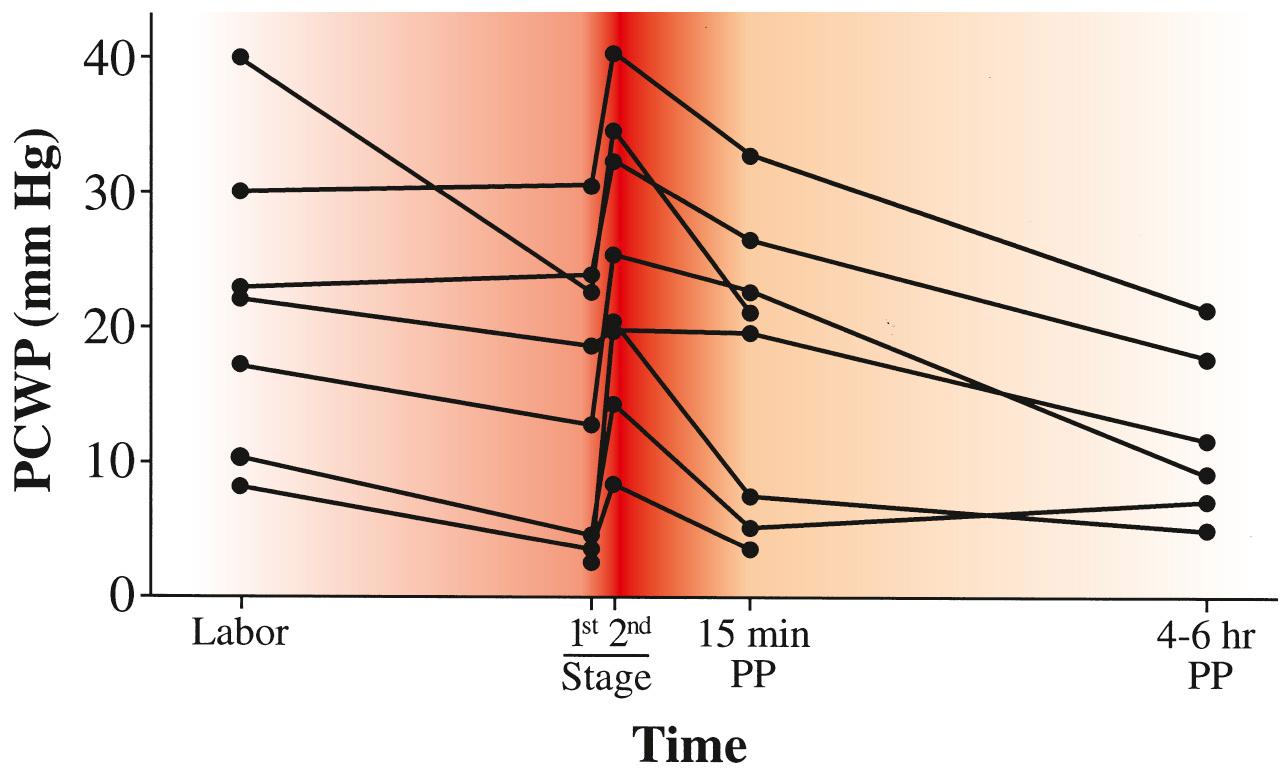 Fig. 42.6, Changes in Pulmonary Capillary Wedge Pressure (PCWP) Associated With Delivery and Subsequent Diuresis in Women With Mitral Stenosis.