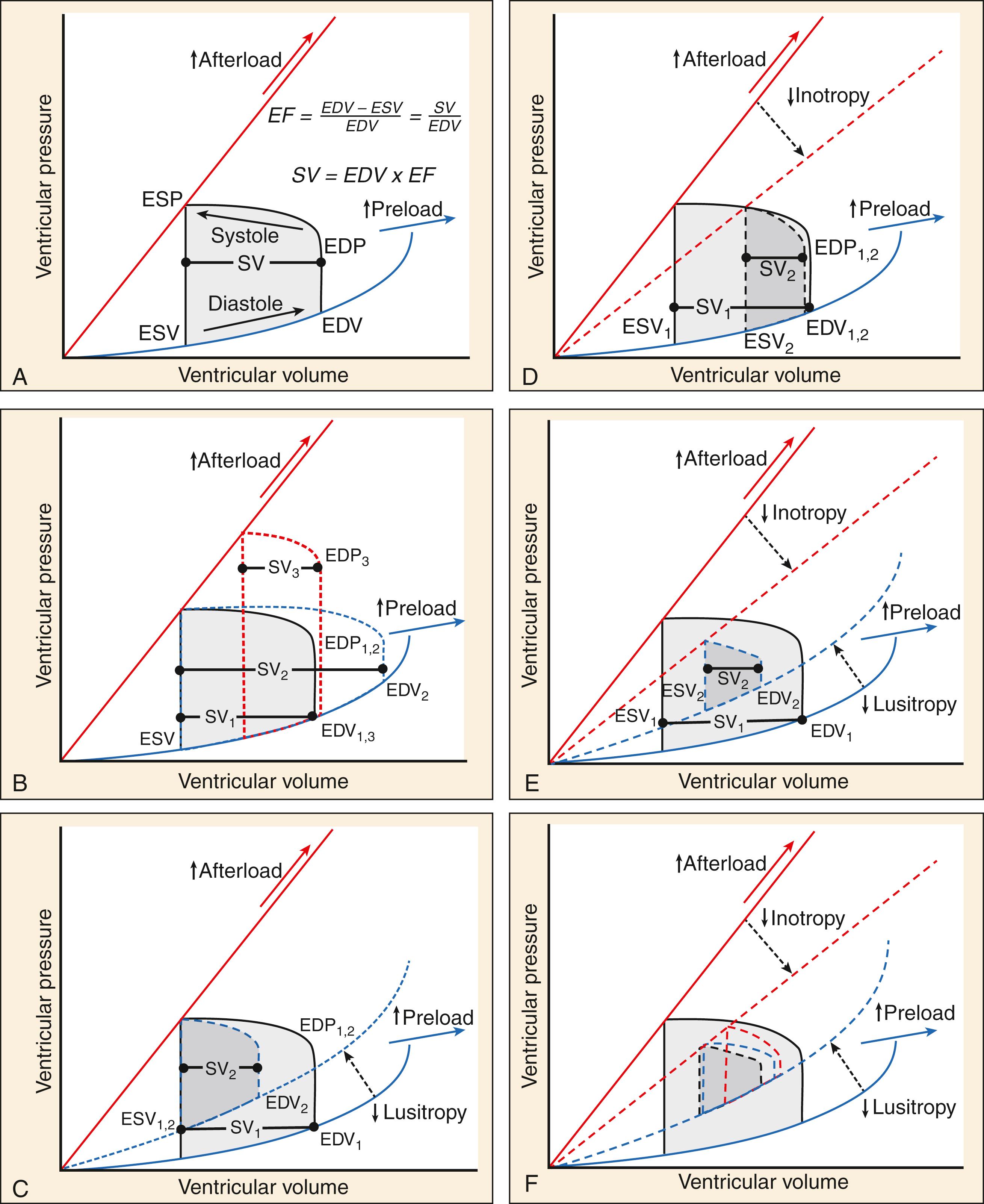 Fig. 67.2, Pressure-volume (PV) loop concept diagrams demonstrating the relationship between underlying cardiac function, SV, and changes in preload or afterload. Each loop is delimited by underlying limits to inotropy (top limit line) and lusitropy (bottom limit line). Stroke volume alterations (by changes in preload and afterload) are limited to these confines. (A) Baseline PV loop of a hypothetical healthy heart. (B) Isolated increases in afterload ( red dotted line ) or preload ( blue line ) under healthy conditions lead to decreased or increased SV, respectively. (C) Isolated impairment of lusitropy (ie, diastolic dysfunction) decreases SV by reducing EDV for a given EDP, ESP, and ESV ( dotted line ). This is representative of many, but not all, cases of HFpEF (since diastolic dysfunction may be isolated or may coexist with systolic dysfunction, even in HFpEF; see panel E). (D) Isolated impairment of inotropy (ie, systolic dysfunction) decreases SV by reducing ESV for a given EDP, ESP, and EDV ( dotted line ). EF is observed to decrease, though the reduction in SV is just as severe as isolated diastolic dysfunction in panel C. This curve is mostly hypothetical because in reality systolic dysfunction is nearly always accompanied by diastolic dysfunction in both HFrEF and HFpEF. (E) Combined inotropic and lusitropic impairment decreases SV by reducing ESV and EDV for a given EDP and ESP. This represents nearly all cases of HFrEF and many cases of HFpEF. (F) Compared to the healthy heart in panel B, preload ( blue dotted line ) has only marginal effects on SV in HF (ie, decreased preload tolerance). For afterload, the direction of effect is the same as the healthy heart: increased afterload reduces SV ( red dotted line ) when all other parameters are held constant. SV , stroke volume; EF , Ejection fraction; EDP/ESP/EDV/ESV , end-diastolic/systolic pressure/volume; HF , heart failure; HFpEF , HF with preserved EF; HFrEF , HF with reduced EF.