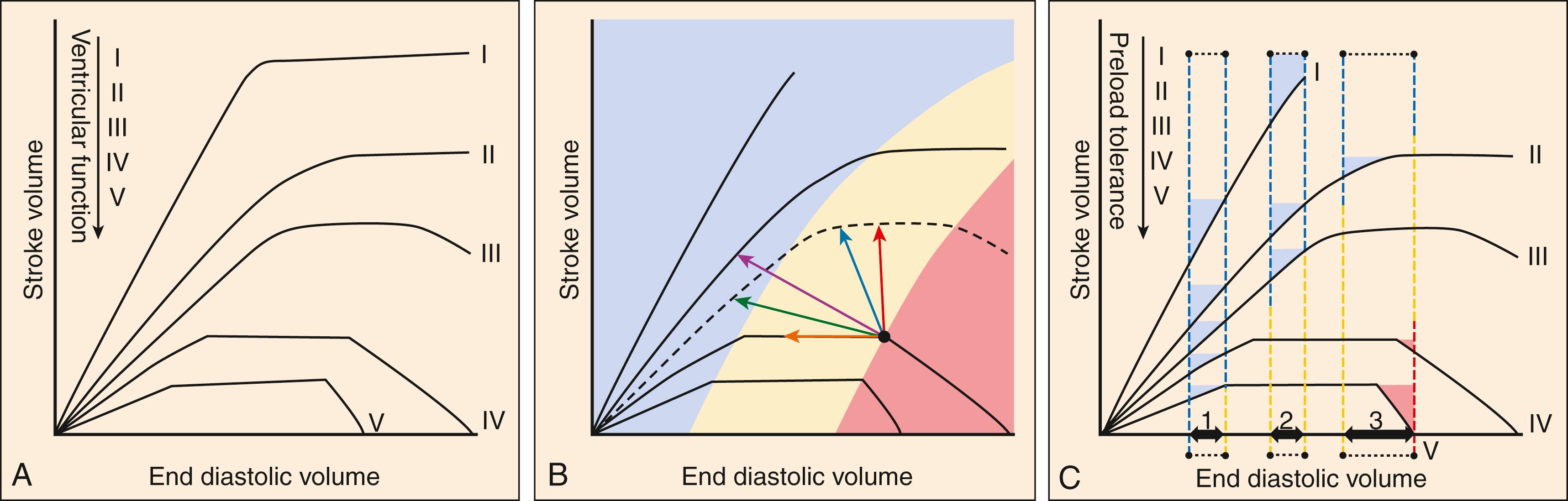 Fig. 67.4, SV versus preload curves describing the Starling mechanism in the context of AHF versus health. (A) Curves I through V represent progressive worsening of baseline cardiac function. Increased preload leads to increased SV early because of more favorable sarcomeric configurations in myocytes. Once all sarcomeres are at a maximal degree of stretch the ability to increase SV by preload is exhausted, and the curve levels off. At severe degrees of stretch, sarcomere configurations become disorganized and stretch-related myocyte injury mechanisms are activated, causing the curve to potentially invert with more preload (“falling off the Starling curve”). The inflection points of leveling off and then of curve inversion occur at less extreme levels of preload as cardiac pump function worsens. (B) For any given preload, patients with cardiac pump dysfunction (IV–V) are more likely to be in the flat or inverted part of the Starling curves ( yellow and red zones , respectively) compared to those with normal or excellent pump function (I–III), and far less likely to be in the preload responsive part of the Starling curve ( blue zone ). Common ED treatment strategies for AHF either push the patient’s preload “backwards” to a more favorable zone along the same Starling curve (IV diuretics only, orange arrow ), move the patient “up” to a curve with improved cardiac performance (inotropes only, red arrow ), or both (vasodilator only, blue arrow ; vasodilator plus diuretic, green arrow ; vasodilator, diuretic, and inotrope, purple arrow ). (C) Preload tolerance is a conceptualization of whether a patient will benefit, have no change, or sustain harm from a fixed change in preload (intervals/arrows 1, 2, and 3). In AHF, relatively rapid increases in preload occur from intercompartmental fluid shifts, while slower increases occur from progressive volume overload. Interval 1 shows a severely hypovolemic state, in which all 5 patient curves benefit from an increase in preload (eg, a fluid bolus), though SV augmentation is only modest with cardiac dysfunction IV–V. Interval 2 represents a state in which increased central venous volume pushes patients IV–V closer to falling off the Starling curve (while achieving no change in SV), whereas SV is augmented in I–III. In interval 3, further increased central venous volume pushes the patients with myocardial dysfunction “off” the Starling curve, but given the same preload has neutral-to-positive effects for patients I– III. AHF , acute heart failure; SV , stroke volume.