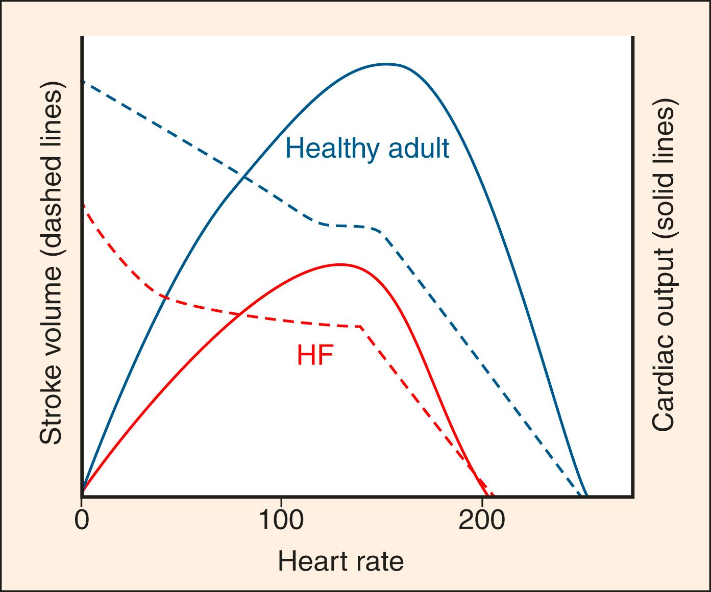 Fig. 67.5, Plot of SV ( dotted line ) or CO ( solid line ) versus HR for healthy and impaired myocardial function ( blue line vs. red line , respectively). Myocardial stimulation in response to physiologic demands (eg, sympathetic drive in response to a physiologic stressor), can compensate by augmenting SV up to a ceiling dictated by the optimization of inotropy and lusitropy. Past this SV ceiling, the only way to augment CO to meet even higher physiologic demand is to increase HR (ie, tachycardia in AHF may signify severe mismatch between myocardial function and metabolic demand). After a certain point of tachycardia, SV will worsen due to insufficient time spent in diastole (ie, de-optimized filling time) and further increases in tachycardia will cause CO to decrease (ie, tachydysrhythmias precipitate hemodynamic instability at extremely high HRs in healthy patients, but at lower HRs in acute or chronic myocardial dysfunction). SV , stroke volume; CO , cardiac output; HR , heart rate; AHF , acute heart failure.