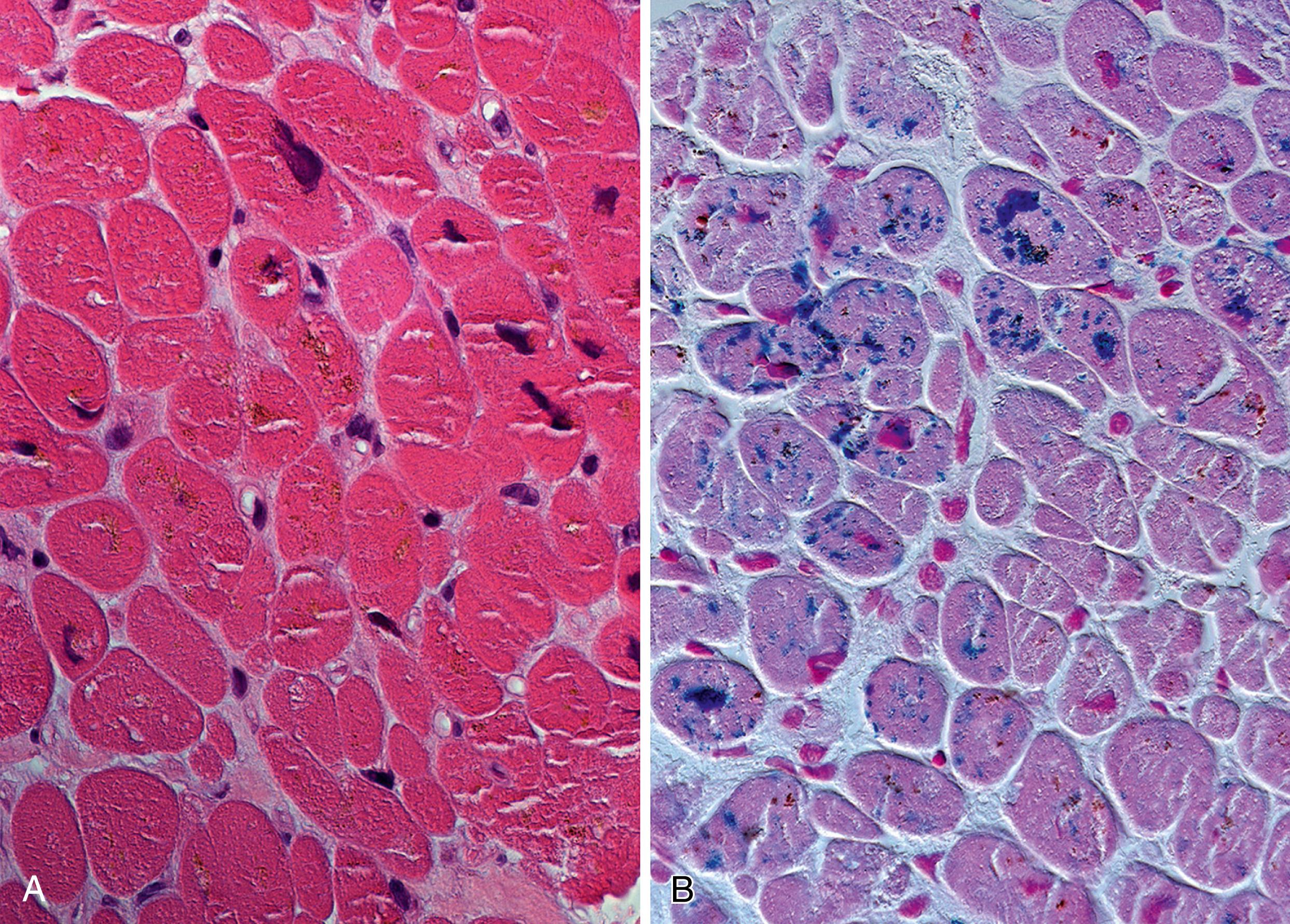 Figure 18.2, Hemochromatosis.