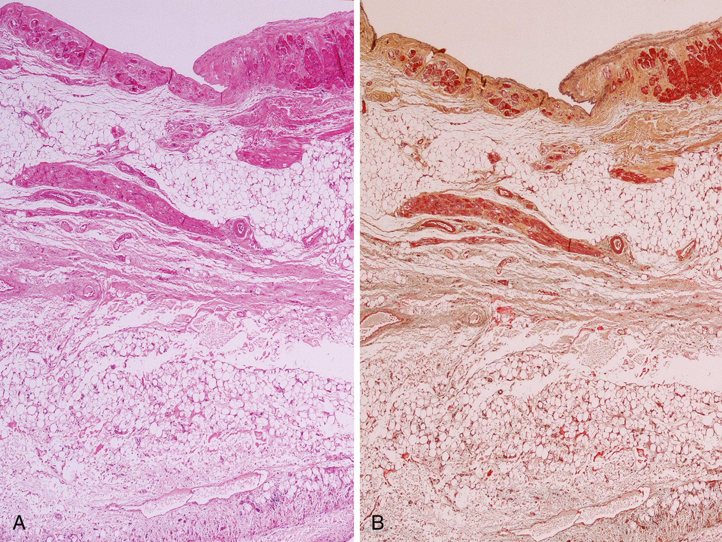 Figure 18.3, Arrhythmogenic right ventricular cardiomyopathy.