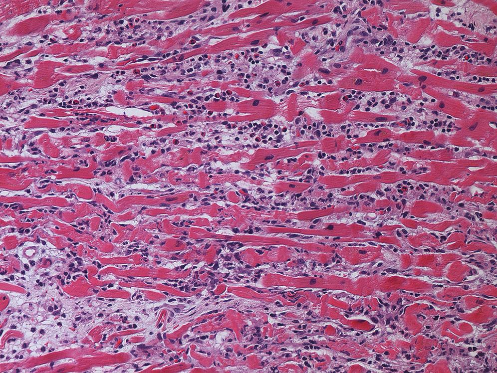 Figure 18.4, Lymphocytic myocarditis.