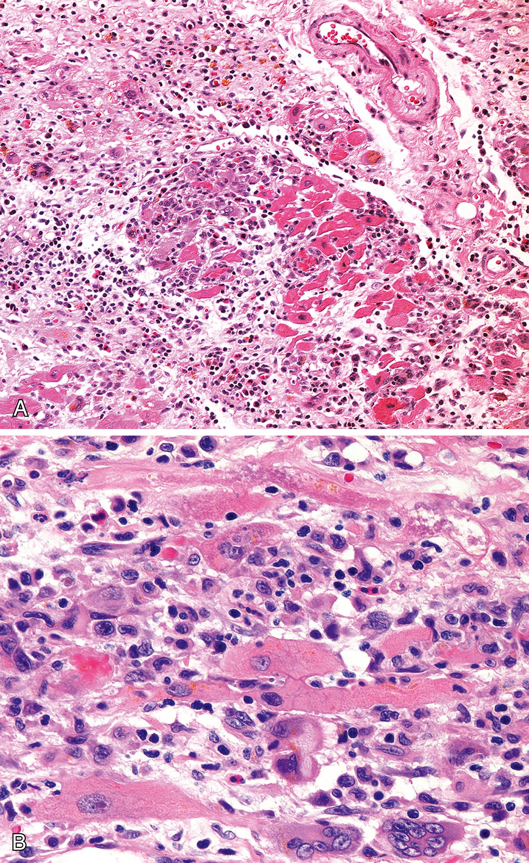 Figure 18.5, Giant cell myocarditis.