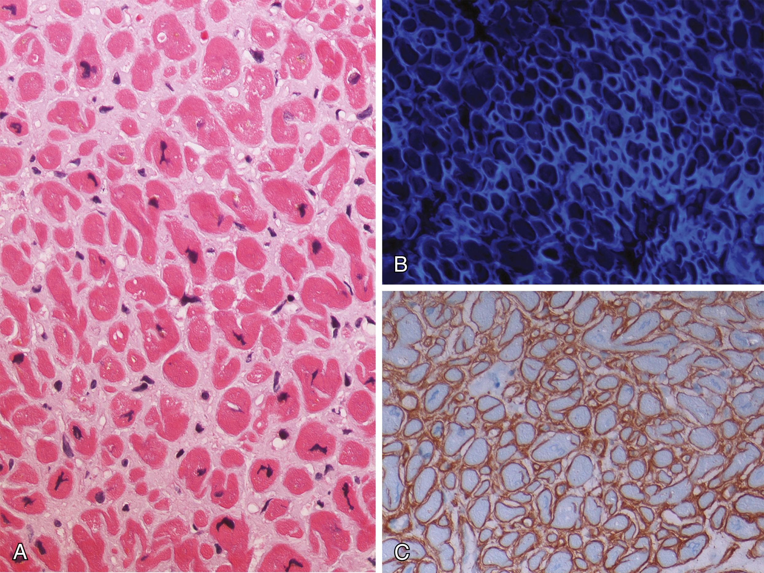 Figure 18.7, Amyloidosis.