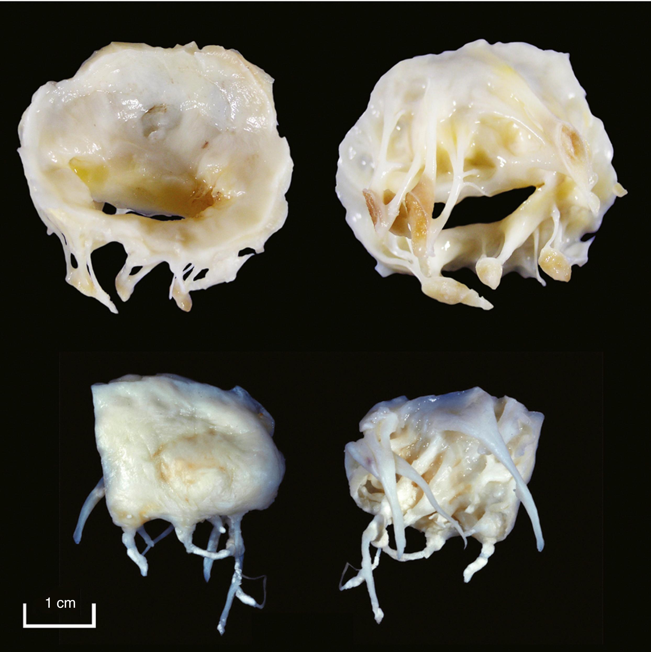 Figure 18.8, Mitral valve.