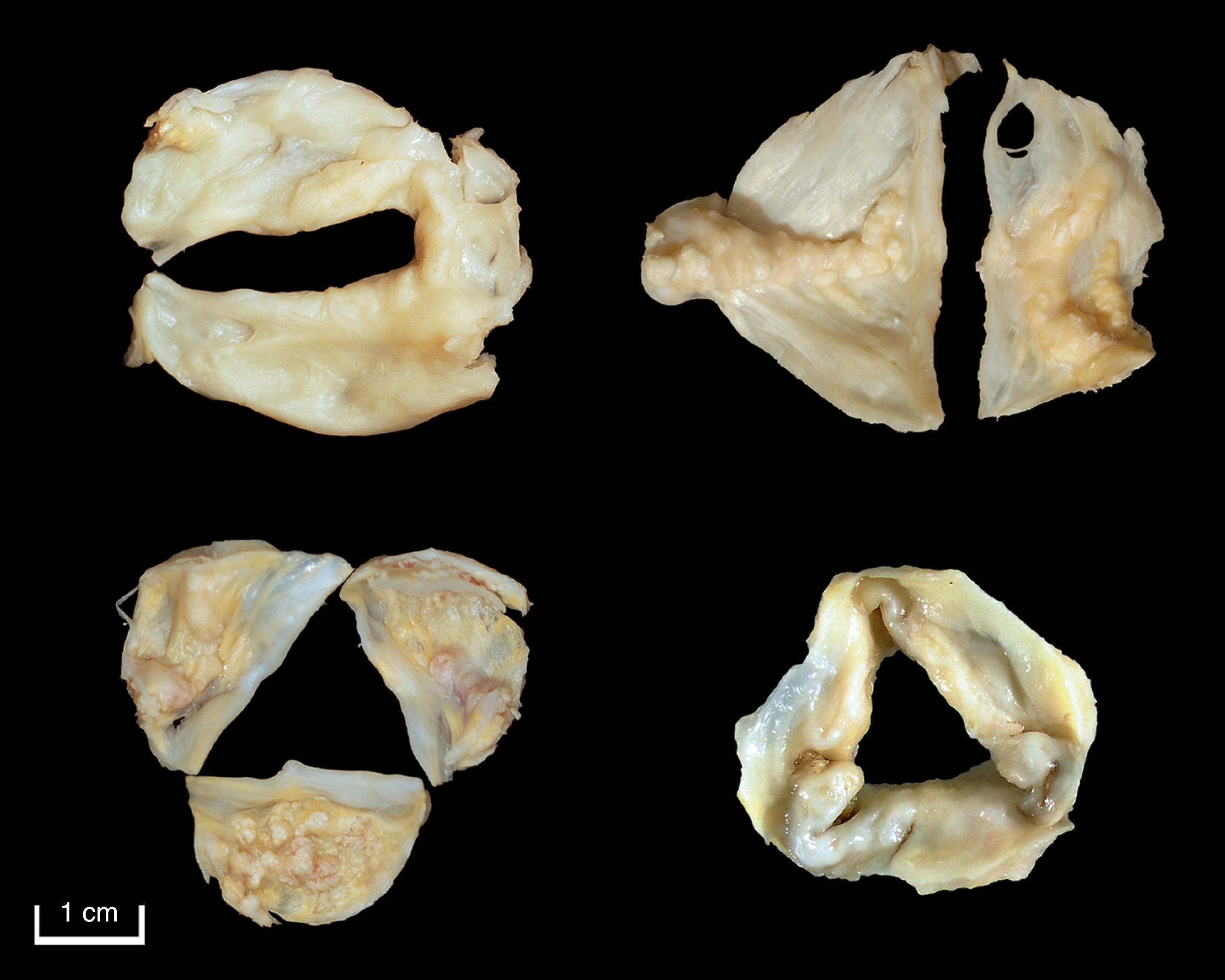 Figure 18.9, Aortic valve.