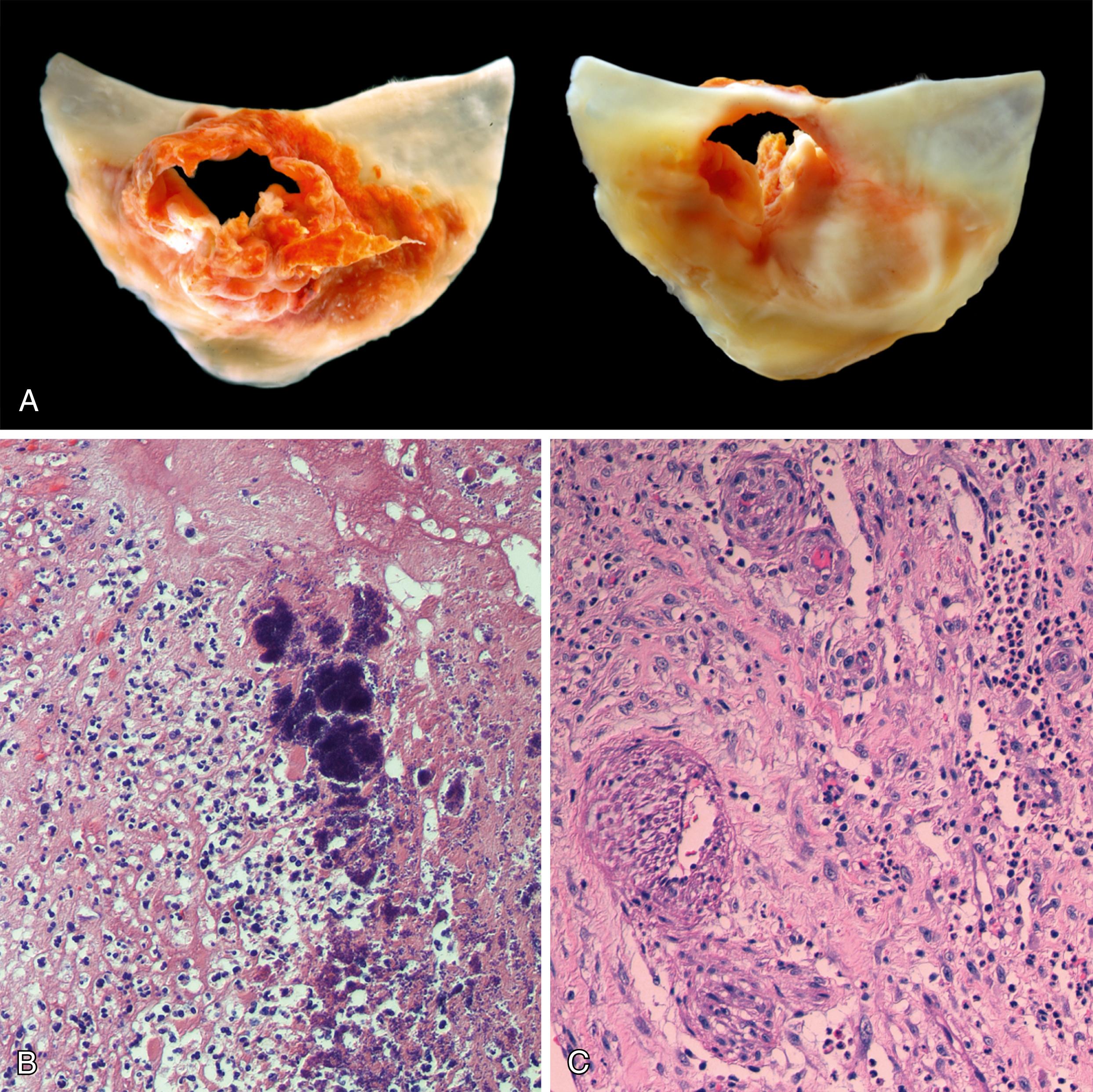 Figure 18.10, Infective endocarditis.