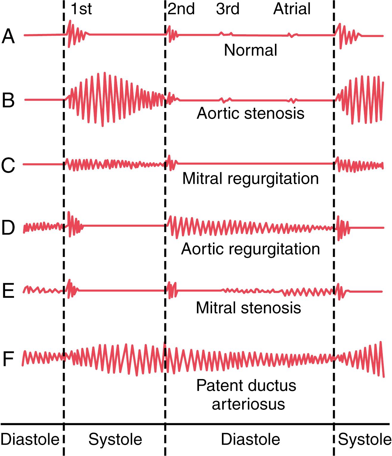 Figure 23-3, A—F, Phonocardiograms from normal and abnormal hearts.