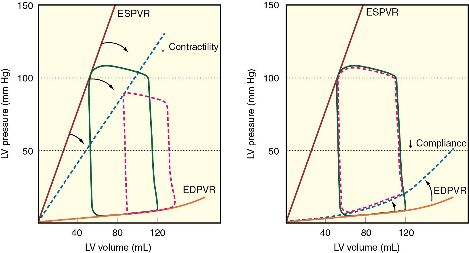 Fig. 10.2, Alterations in left ventricular (LV) pressure-volume loops during heart failure. These schematic illustrations demonstrate alterations in the steady-state LV pressure-volume diagram produced by a reduction in myocardial contractility as indicated by a decrease in the slope of the end-systolic pressure-volume relation (ESPVR; right panel) and a decrease in LV compliance as indicated by an increase in the position of the end-diastolic pressure-volume relation (EDPVR; right panel) . These diagrams emphasize that heart failure may result from LV systolic or diastolic dysfunction independently.