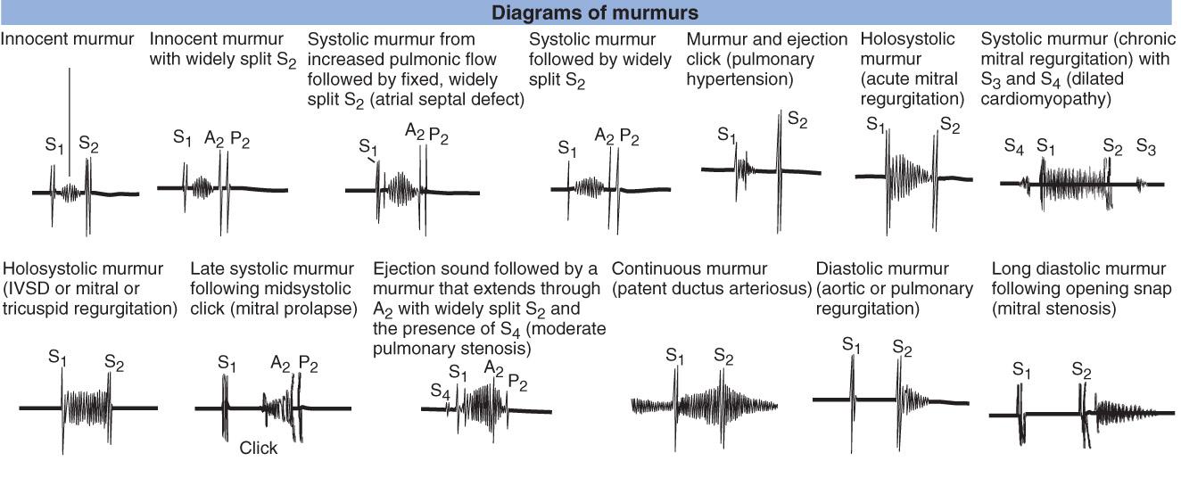 Fig. 2.3, Innocent (functional) and pathologic murmurs. IVSD, Interventricular septal defect; P 2 , pulmonic component of S 2 .