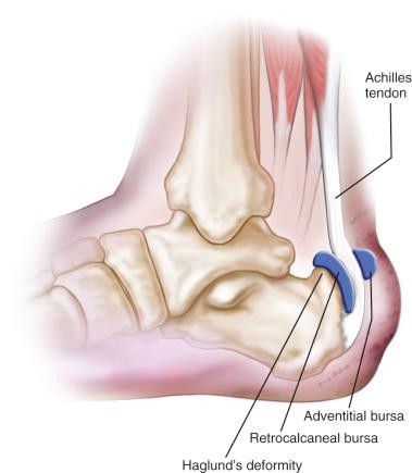 Fig. 120.1, Haglund deformity with a retrocalcaneal bursa between the Achilles tendon and the superior bursal prominence, and an adventitious bursa between the Achilles tendon and the skin.