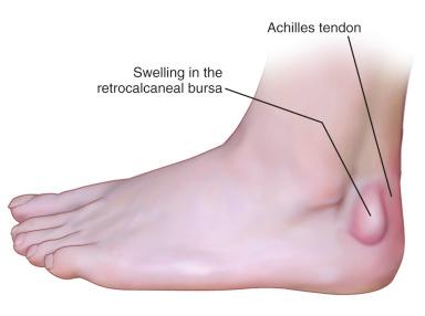 Fig. 120.2, The area of the swelling; retrocalcaneal bursitis with swelling is anterior to the Achilles tendon.