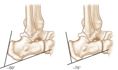 Fig. 120.3, Measurement of the Fowler and Philip angle.