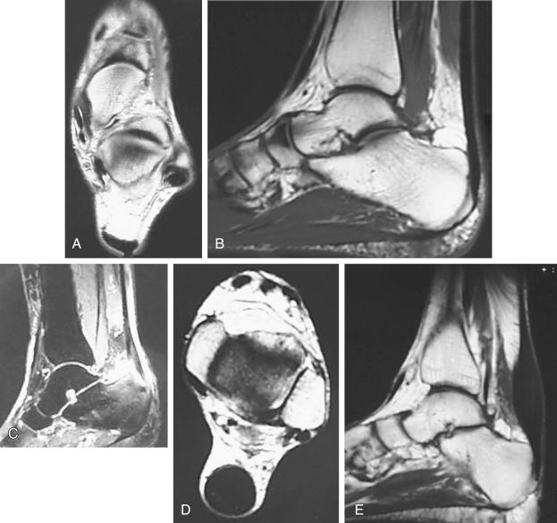 Fig. 120.5, (A) Axial magnetic resonance imaging (MRI) of a normal Achilles tendon showing the normal shape of the Achilles tendon. (B) A sagittal MRI scan of a normal Achilles tendon showing the normal shape of the Achilles tendon. (C) A sagittal MRI scan showing increased signal in the insertion of the Achilles tendon consistent with tendinosis. Increased fluid is present, demonstrating an inflamed bursa surrounding Haglund deformity. (D and E), Axial and sagittal MRI scans demonstrating chronic tendinosis of the Achilles with marked fusiform swelling of the tendon.