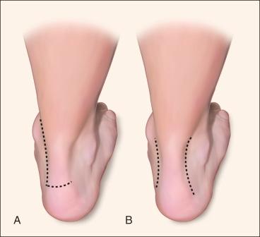 Fig. 120.6, Surgical incisions for retrocalcaneal bursitis.