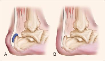 Fig. 120.7, (A) Haglund deformity with prominence of the posterior superior portion of the os calcis. (B) The appearance of os calcis after surgical resection of a posterior superior prominence for symptomatic Haglund deformity.