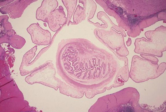 FIGURE 27-4, Neurocysticercosis depicting larva containing invaginated neck region in brain.