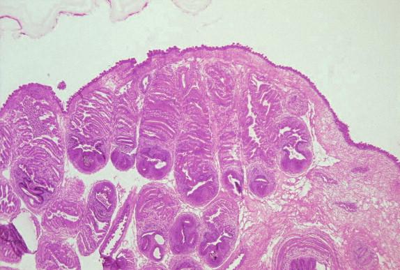 FIGURE 27-5, Coenurus from chest wall with multiple invaginated protoscolices attached to cyst wall.