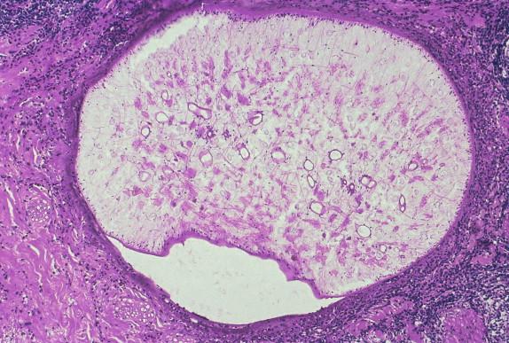 FIGURE 27-6, Viable sparganum provoking acute inflammation in the dermis of scrotal skin. Note loose parenchyma with excretory channels and smooth muscle fibers.