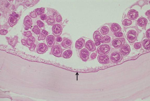 FIGURE 27-7, Echinococcus granulosus metacestode (hydatid cyst) in liver illustrating laminated membrane, germinal membrane (arrow), and brood capsules containing protoscolices.