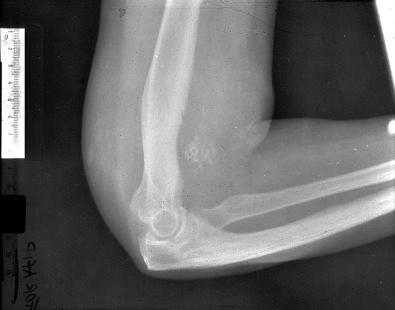 Fig. 21.1, Plain film of arm showing epithelioid hemangioendothelioma of distal arm that has created erosion of bone. The mass is also partially calcified.