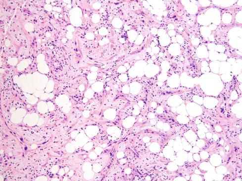 Fig. 21.11, YAP-TFE3 –rearranged “epithelioid hemangioendothelioma.” Tumor differs from classic epithelioid hemangioendothelioma by formation of multicellular vascular channels and associated inflammatory infiltrate.