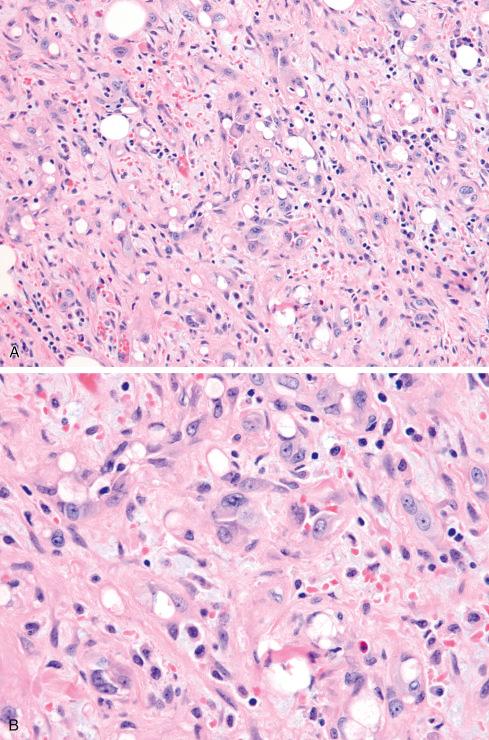 Fig. 21.12, YAP-TFE3 –rearranged “epithelioid hemangioendothelioma” showing multicellular vascular channels ( A ) lined by epithelioid endothelial cells, some containing vacuoles ( B ). Some features resemble epithelioid hemangioma.