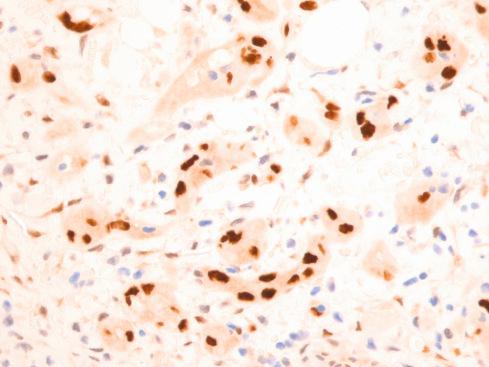 Fig. 21.13, Nuclear TFE3 immunostaining of a YAP-TFE3 –rearranged “epithelioid hemangioendothelioma.”