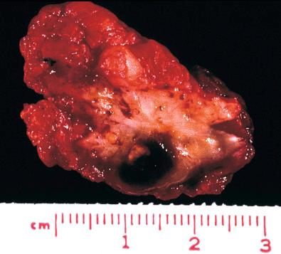 Fig. 21.2, Gross specimen of epithelioid hemangioendothelioma. The tumor resembles an organizing thrombus in a small vein.