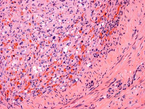 Fig. 21.4, Epithelioid hemangioendothelioma showing confinement by vein wall.