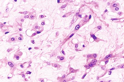 Fig. 21.6, Epithelioid hemangioendothelioma showing prominent cytoplasmic vacuolization that “blisters” the cell.