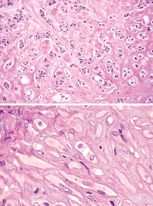 Fig. 21.7, A and B, Hyalinization of stroma is common in epithelioid hemangioendothelioma.