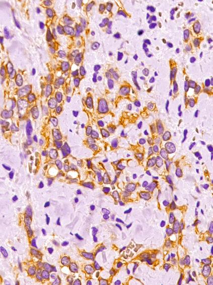 Fig. 21.8, Membranous CD31 immunostaining of epithelioid hemangioendothelioma.