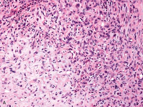 Fig. 21.9, A, Epithelioid hemangioendothelioma showing transition to more cellular atypical areas in which B, malignant-appearing cells grow in intravascular, papillary fashion.