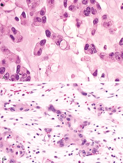 Fig. 21.10, Epithelioid hemangioendothelioma with cytologically malignant features. In some cases, A, the cordlike pattern and cytoplasmic vacuoles may be quite apparent, whereas in others, B, the tumor may assume a more solid pattern easily mistaken for conventional angiosarcoma.