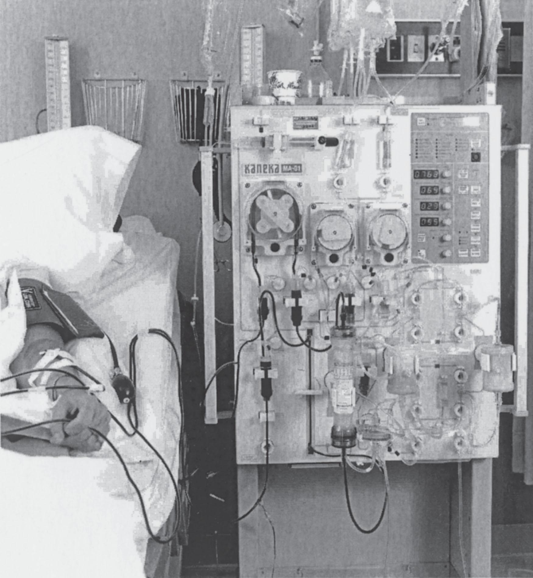 Figure 116.4, TWO-STAGE THERAPEUTIC PLASMAPHERESIS.