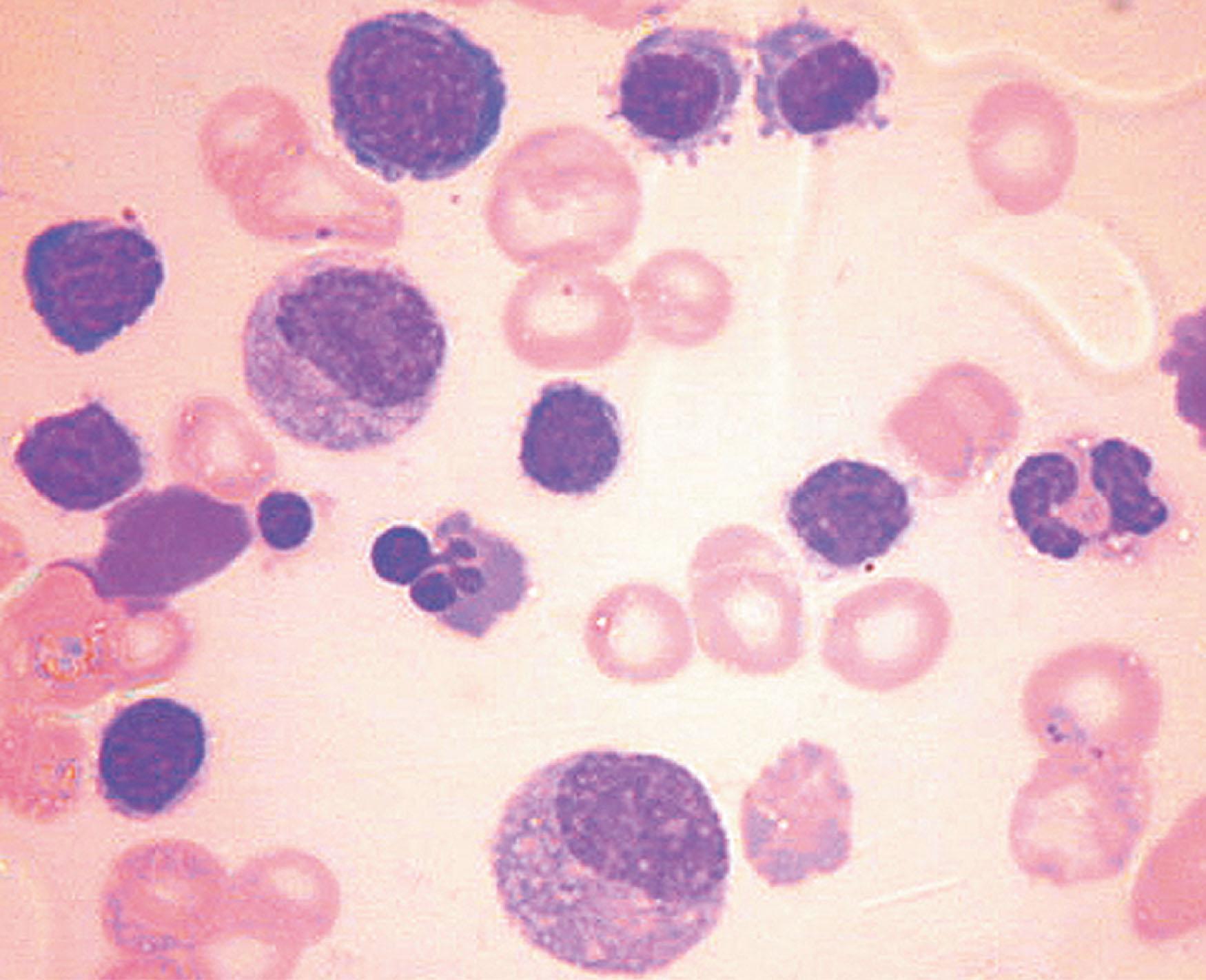Figure 154.4, BONE MARROW ASPIRATE IN MALARIA.