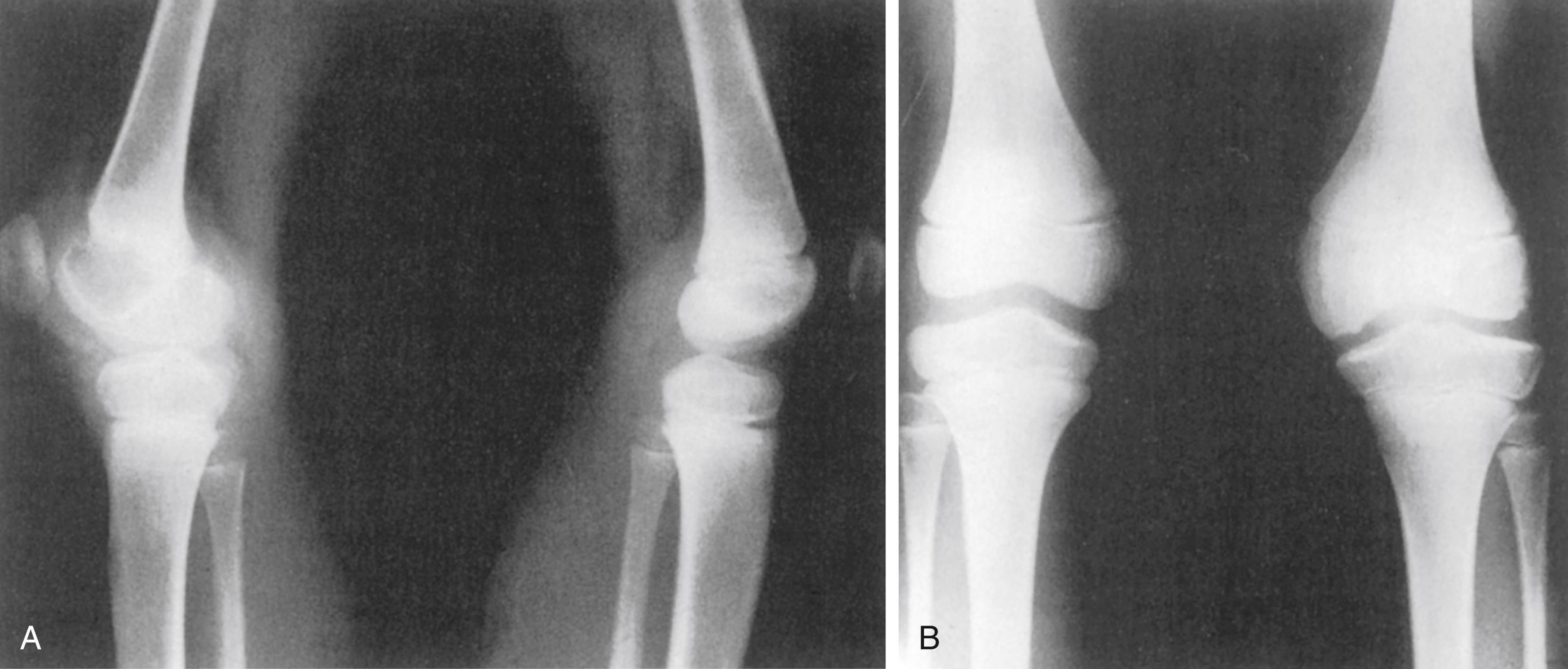 FIG. 39.1, (A) Hemophilic arthropathy of the left knee. (B) The right knee is provided for comparison. Radiographs show the chronic synovitis and enlargement of the distal femoral epiphysis.