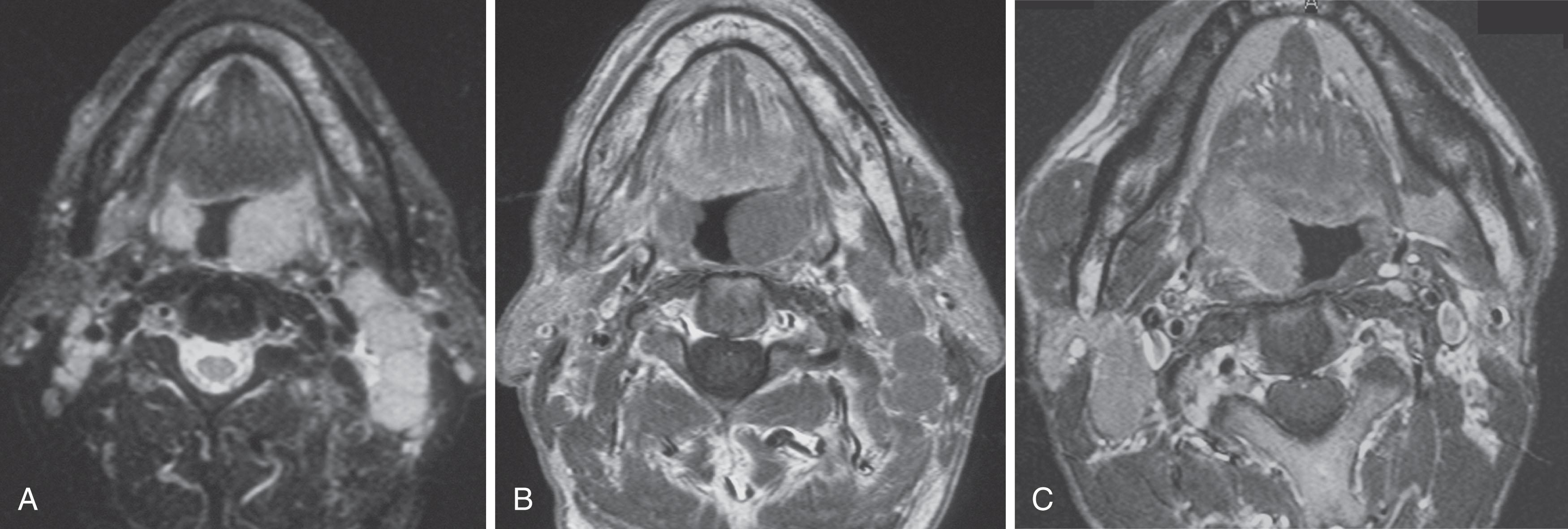 Figure 30.2, A , Axial T2-weighted magnetic resonance imaging scan demonstrates lymphomatous involvement of both tonsillar fossae with enlarged high–T2 signal lymph nodes on the left. Notice high T2 signal in multiple normal-sized right level 2 lymph nodes. B , Corresponding T1-weighted scan demonstrates uniform intermediate signal in the involved lymph nodes. C , Same patient at a higher level. After intravenous contrast, there is uniform moderate enhancement of a right level 2 node and a right tonsillar fossa mass.