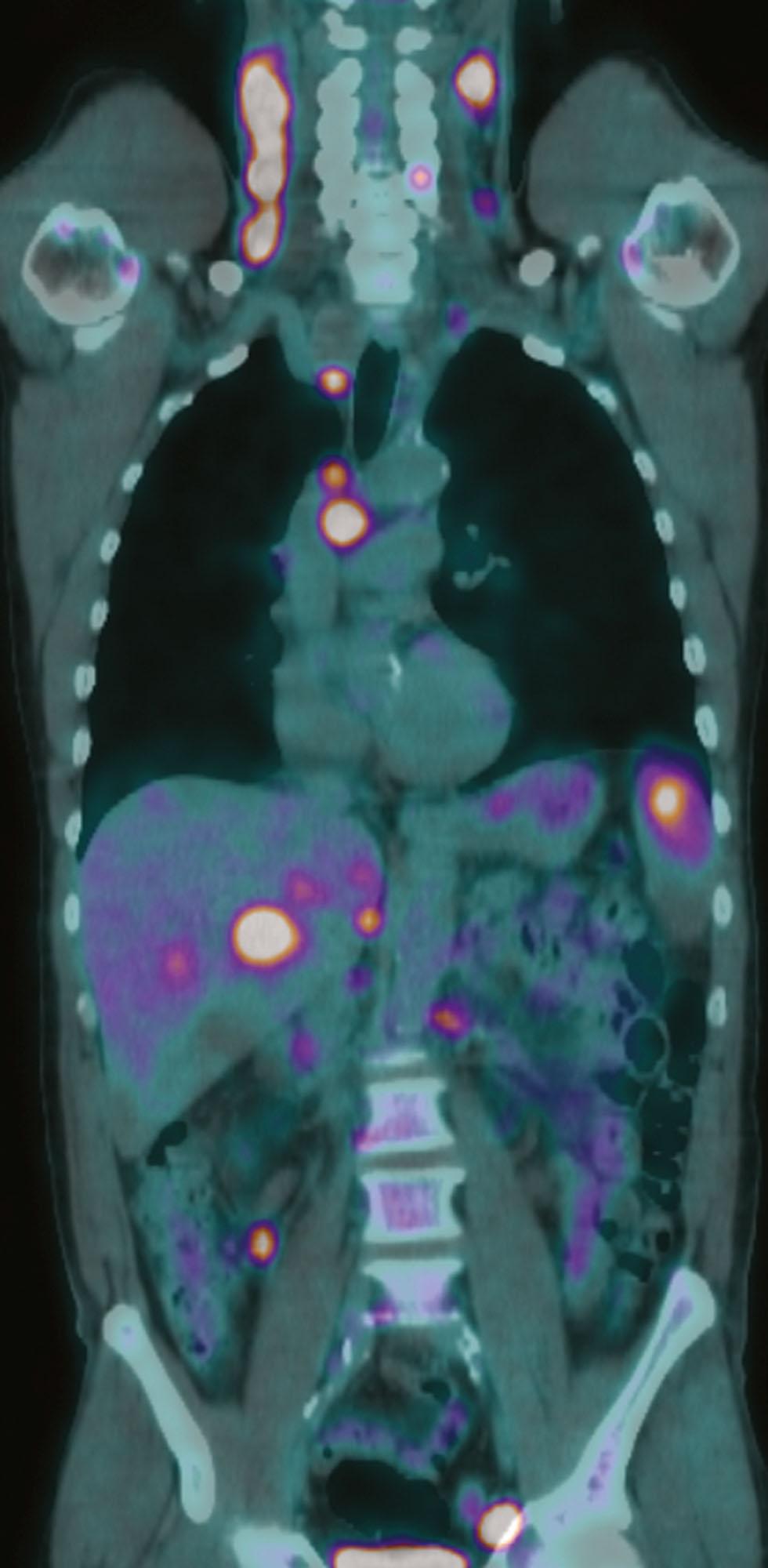 Figure 30.3, Coronal fused positron emission tomography computed tomography (PET/CT) image in a patient with stage II Hodgkin lymphoma on conventional CT. There are regions of increased tracer uptake in the liver, spleen, and bone, indicating stage IV disease.