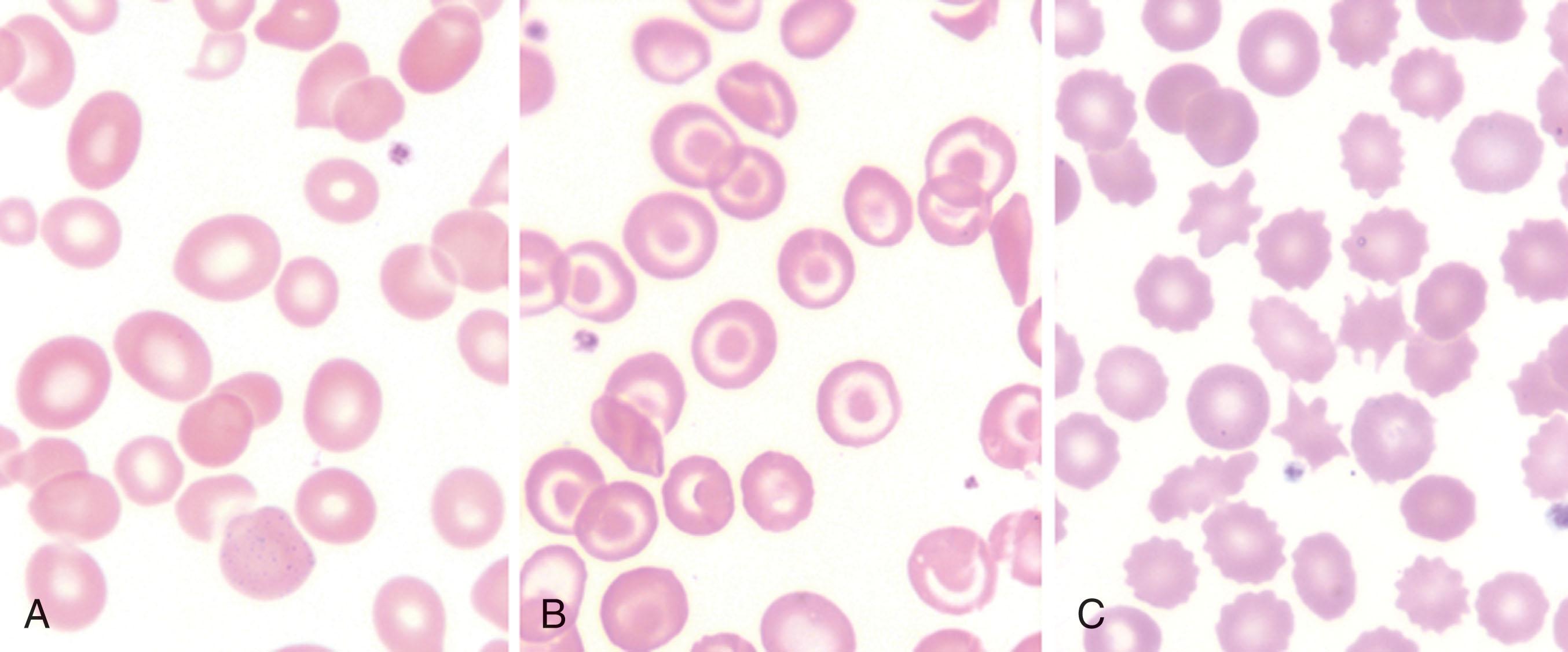 Figure 150.1, RED BLOOD CELL MORPHOLOGY IN LIVER DISEASE.