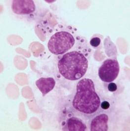 Figure 37-3, Histoplasmosis in the bone marrow.